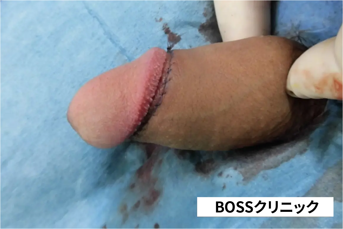 仮性包茎治療後の症例写真